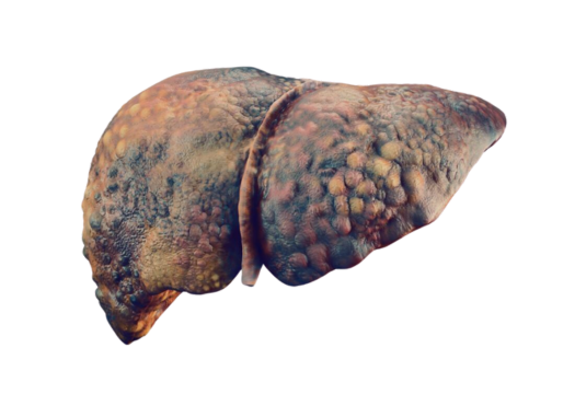 Alcoholic Liver Disease